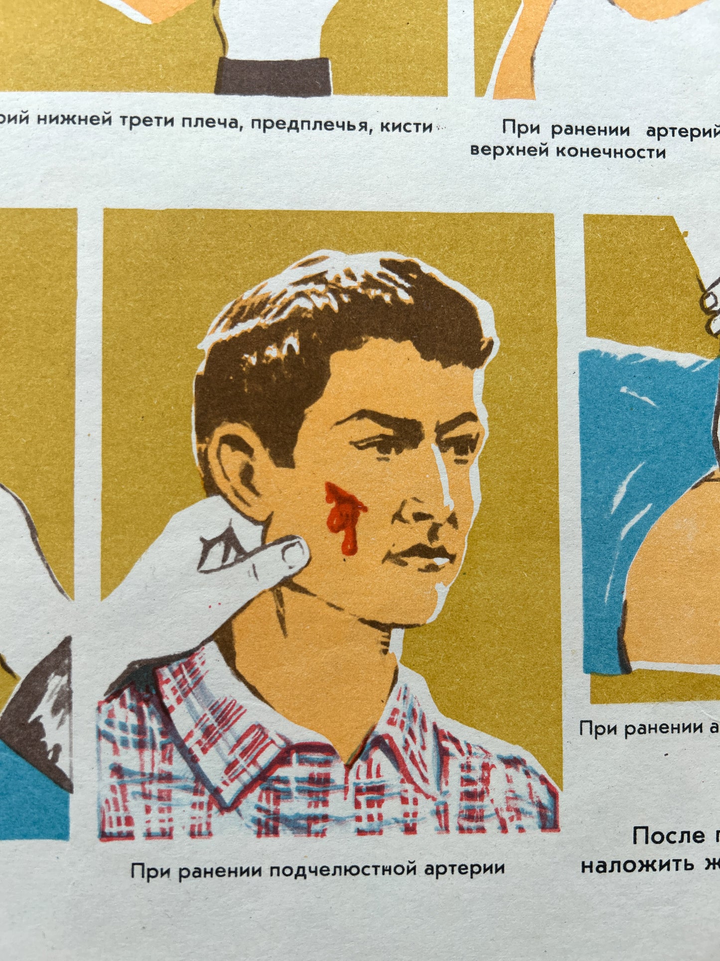 A close-up of a USSR vintage illustrated medical poster about first aid during bleeding with Russian text, showing a man with a bloody cut on his cheek and a hand touching his face.